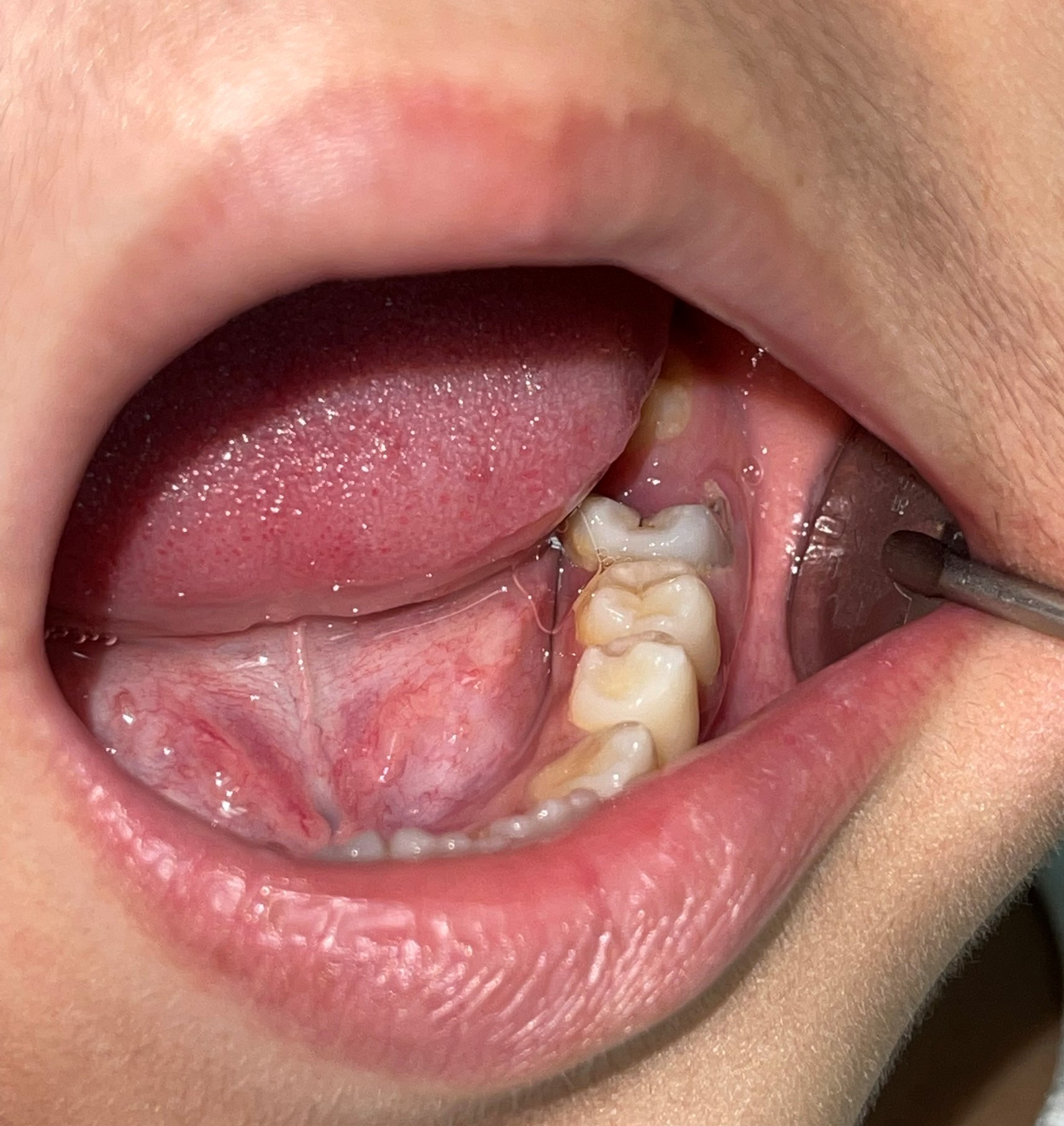 sâu răng số 6